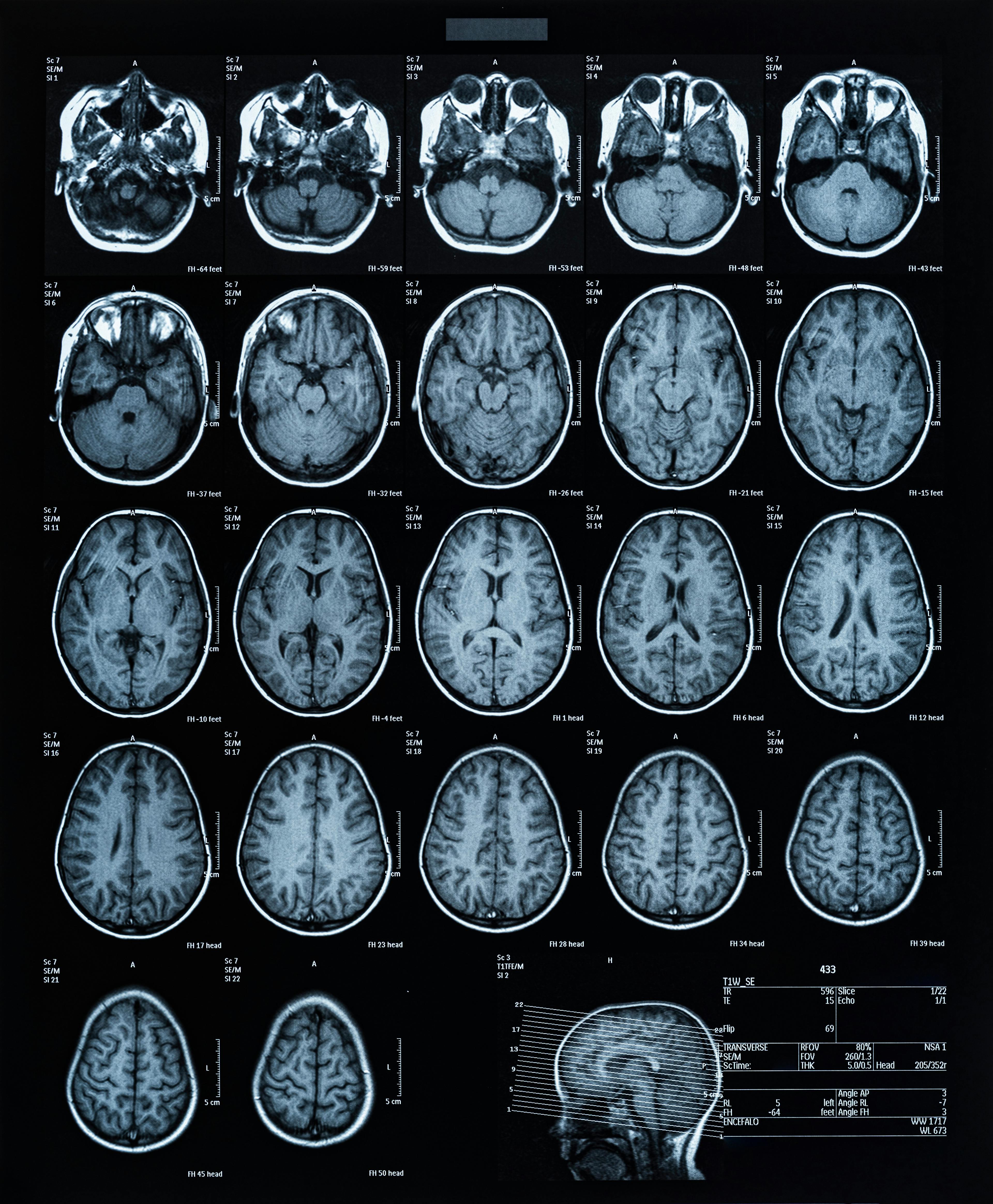 health medical image of an mri of the head showing the brain. Magnetic resonance image.